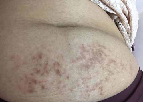 คันท้อง