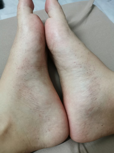 มีผื่นขึ้นข้างเท้าละตามซอกมือ ตั้งครรภ์ได้ประมาณ20สัปดาห์