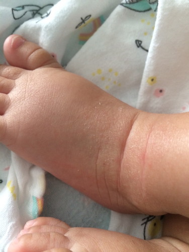 สอบถามหน่อยค่ะผิวน้องแห้ง ขุน บางจุดเป็นเหมือนผดขาวๆ บางจุดผิวสากเกิดจากอะไรคะ