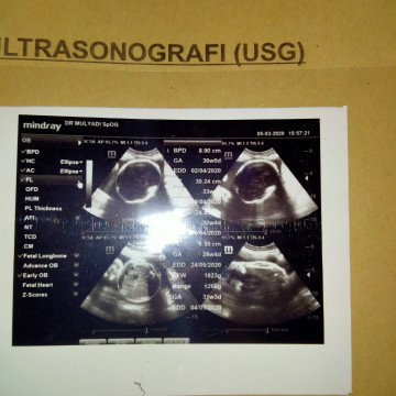 sungsang 34wk