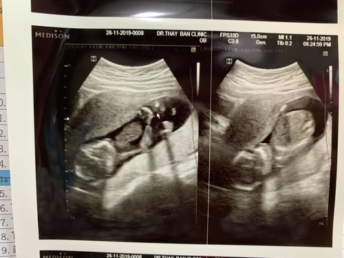 ตั้งครรภ์17wลูกกลับหัวอันตรายไหมคะ