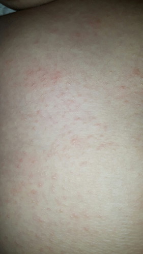 rashes
