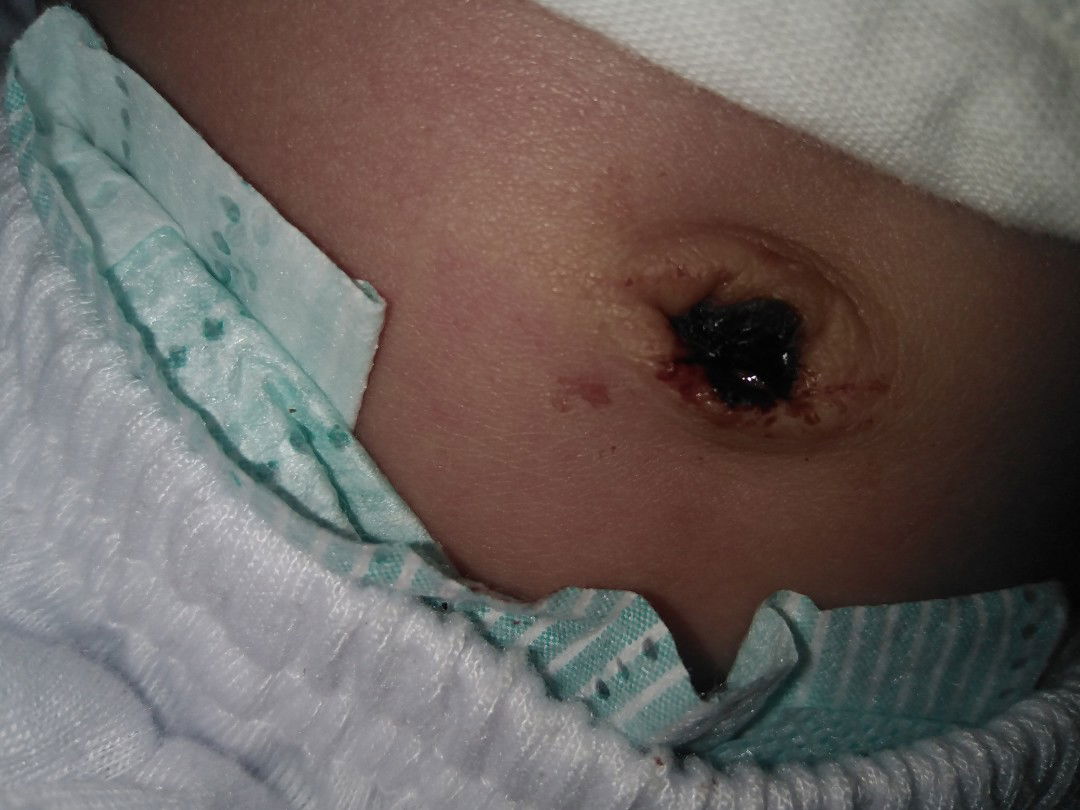 Belly Button Bleeding. ??????