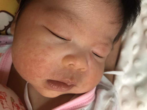 ปรึกษาแม่ๆหน่อยค่ะ หน้าน้องเริ่มจากตุ่มแดงๆใส่เล็กๆ เริ่มเยอะขึ้นเรื่อยๆ พอวันที่3ใช้ยาทา ไป3วัน ยังไม่ดีขึ้น เลยหยุดทา3วันตามคำแนะนำของเจ้าขอผลิตภัณฑ์ พอหยุดทาก็เป็นเหมือนเดิมค่ะ