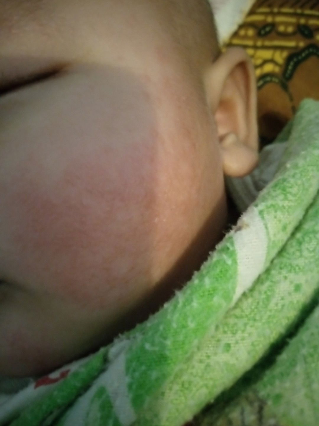 pipi bayi merah dan gatal