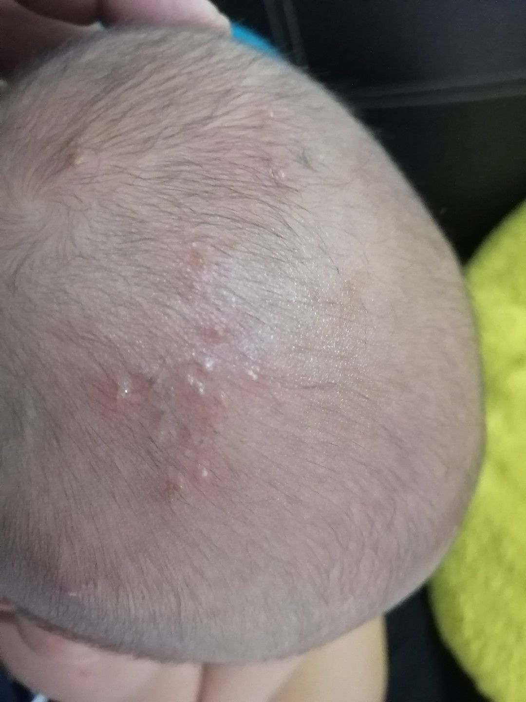 ศรีษะน้องมีตุ่มขึ้นเหมือนสิว