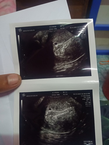 สรุปคือท้องจริงๆต่อไปก้อต้องมาลุ้นว่าท้องลมรึป่าว