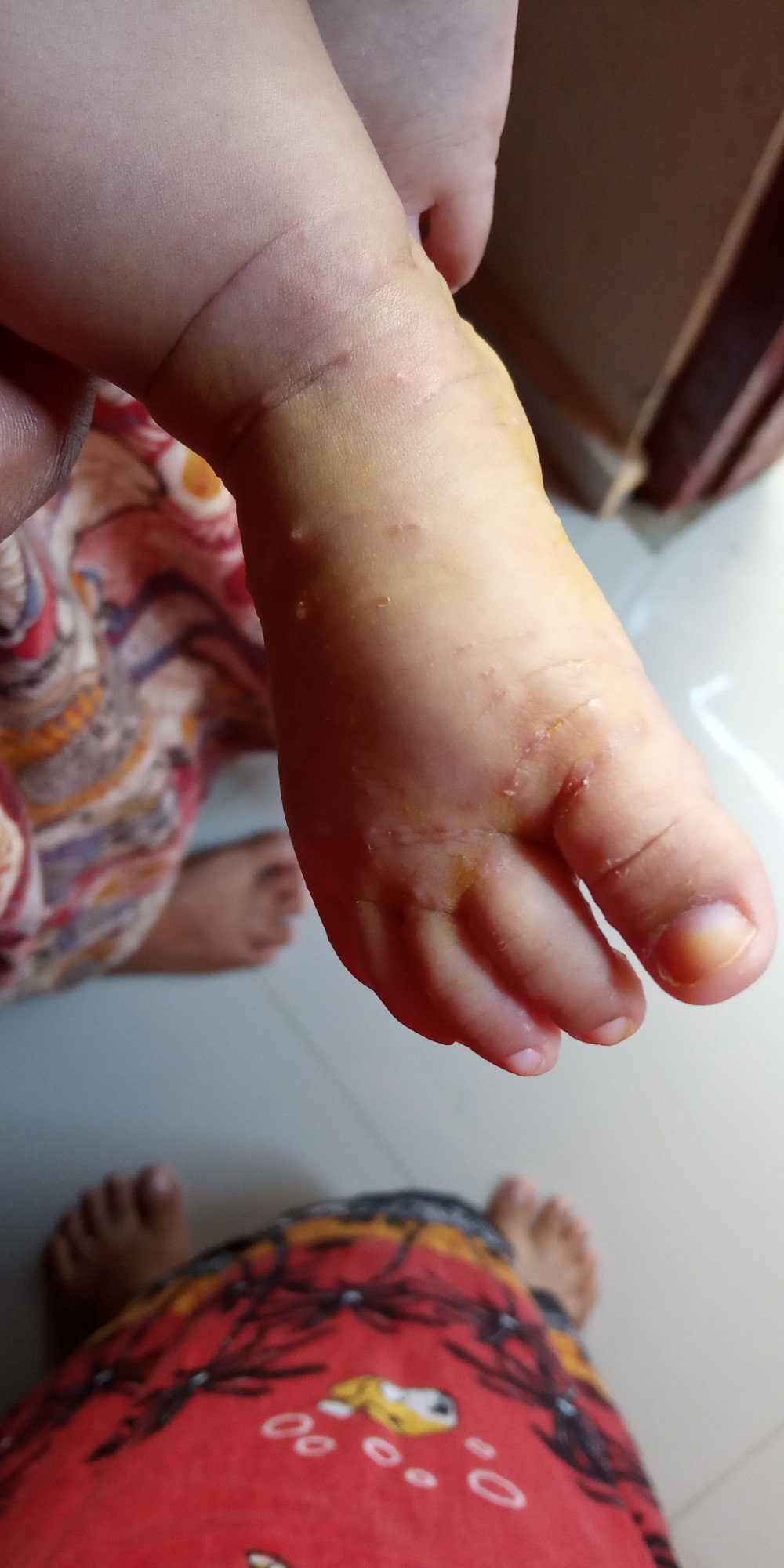 kaki bruntusan
