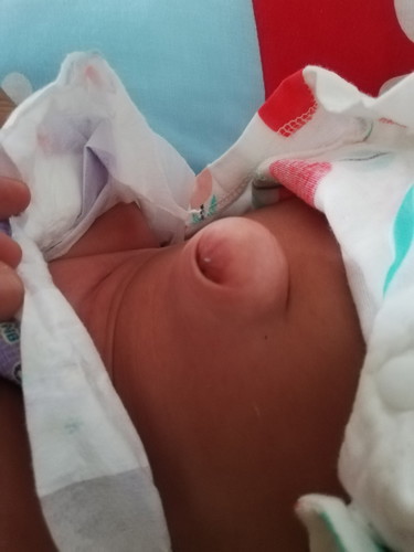 สะดื้อปูด