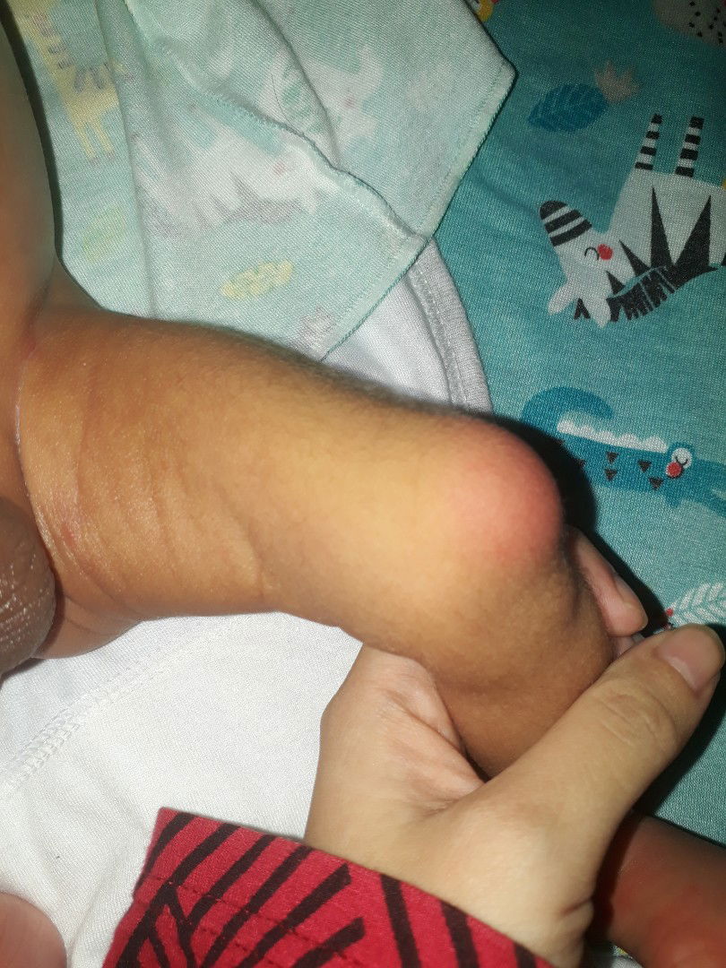 kulit bayi kemerahan dan bengkak