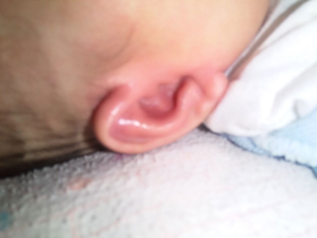 daun telinga atas berair