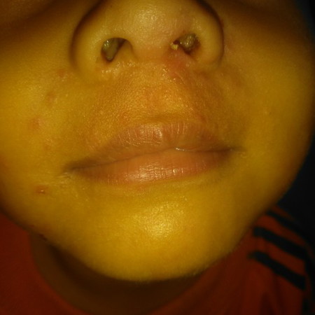 gatal2