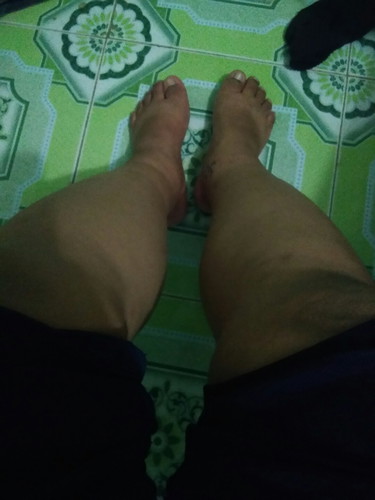 ขาบวม