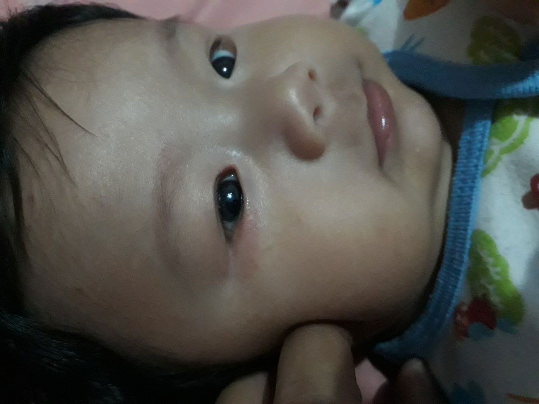 mata bayi iritasi