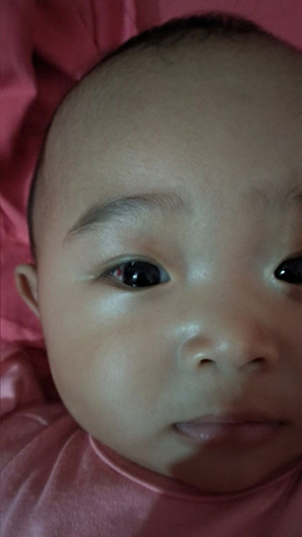 Bercak merah pada mata