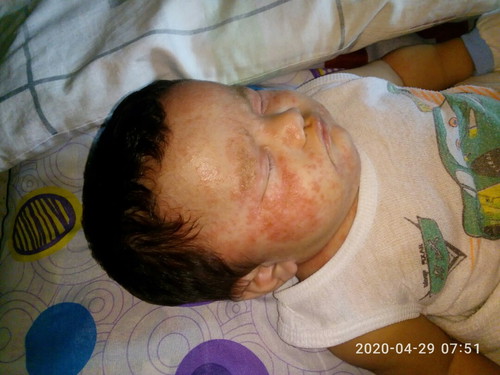 Rashes/Eczema