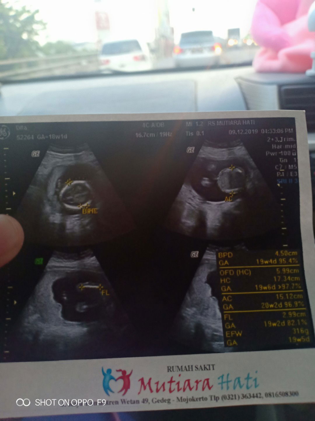 ketakutan akan previa krn sering pendarahan