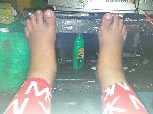 anu pong mabisang pantanggal ng manas