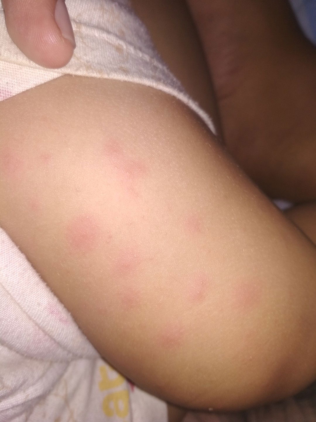 bentol merah di tangan dan kaki