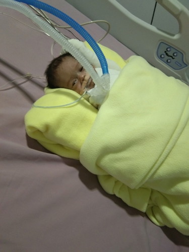 premature baby... #Suhe...
