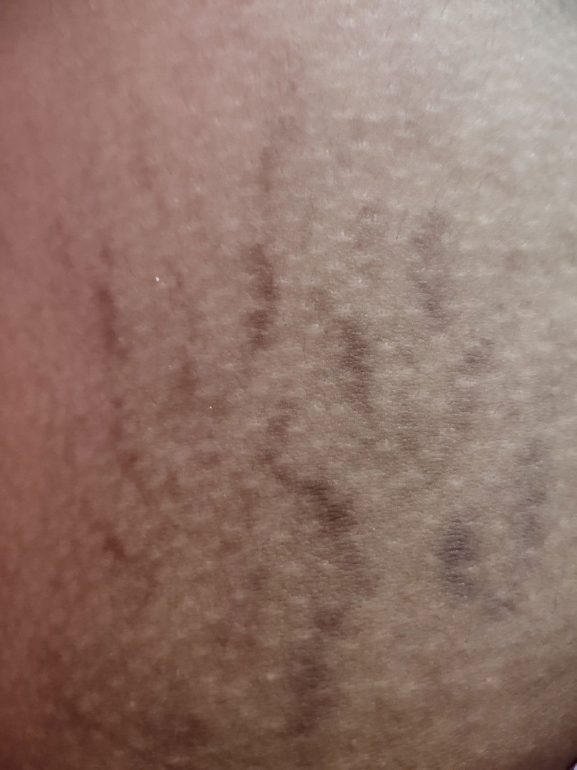 Strerch mark