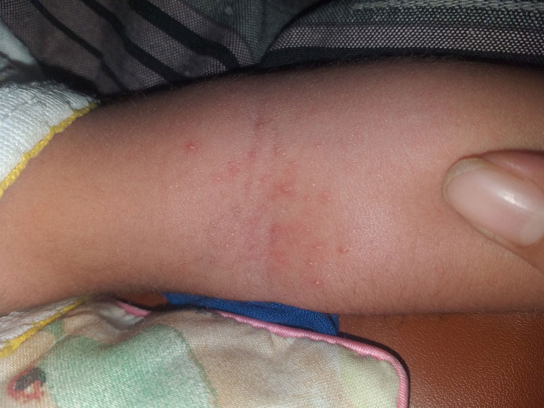bintik2 pada kulit bayi