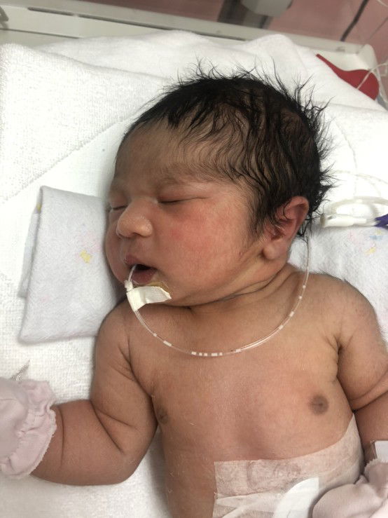 ทีมมิถุนาคะ 37วีค นน.3โล1คะ หลังจากปวดท้องย3วัน สุดท้ายได้ผ่าคะ