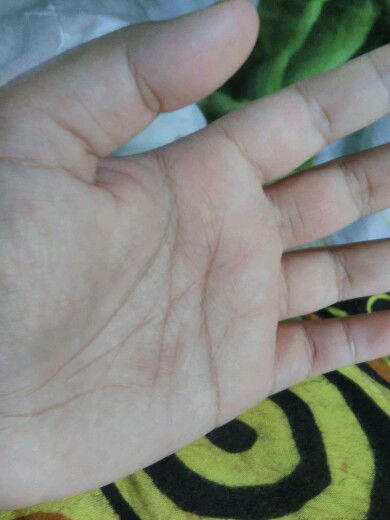 telapak tangan gatal