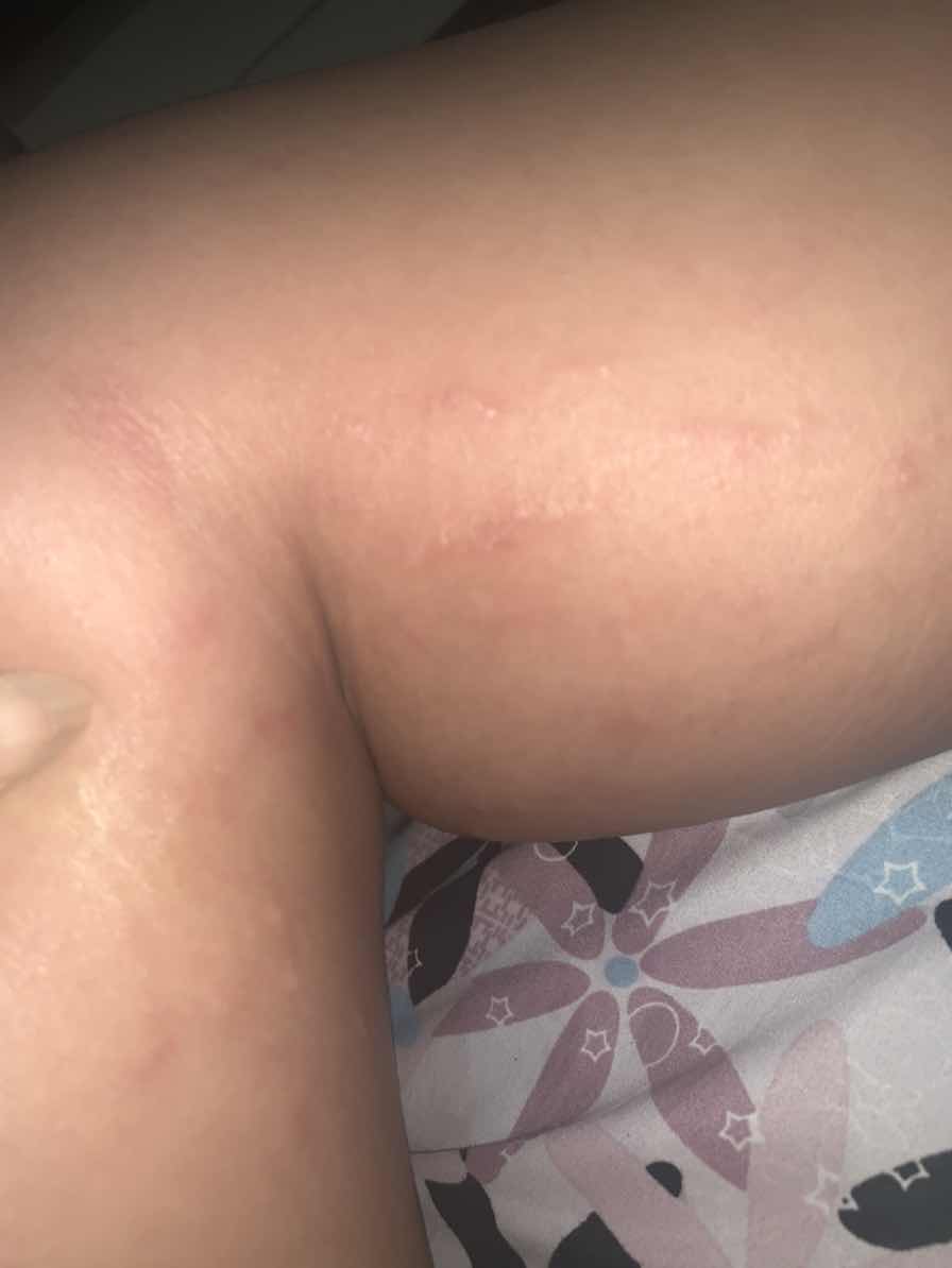 Gatal2 pada usia kehamilan 27 Weeks