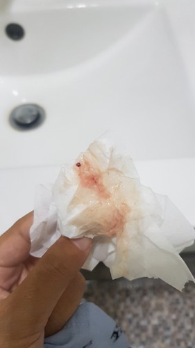 ท้อง 23 week + 5 day มีเลือดออก