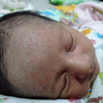 gatal dijidat ada yg tau obatnya untuk bayi 8hari