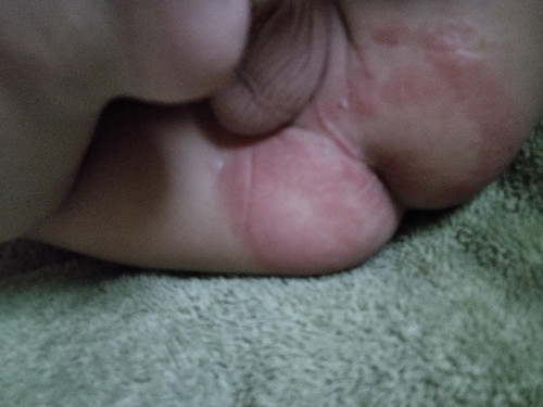 diaper rash