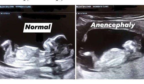 DR IMELDA BALCHIN *PENTINGNYA FOLIC ACID