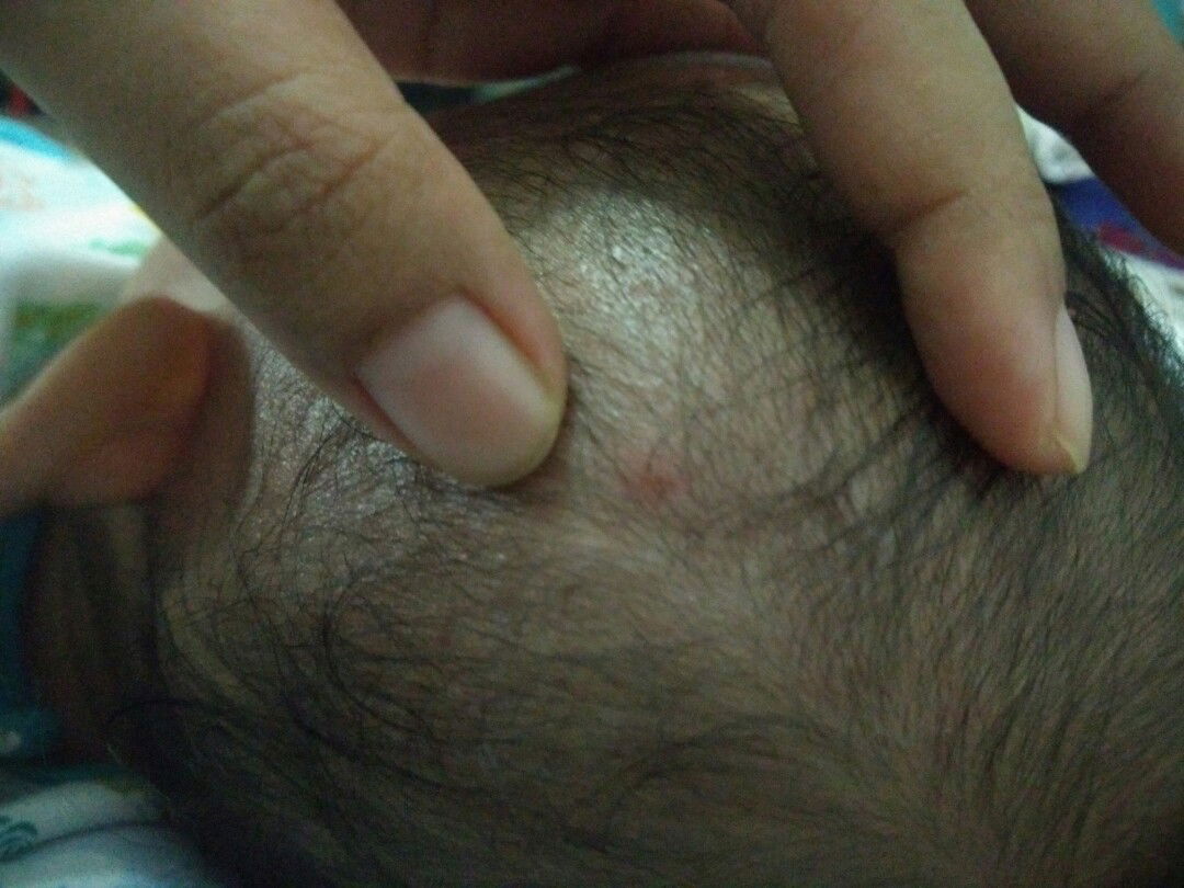 Jerawat Di Kepala Bayi