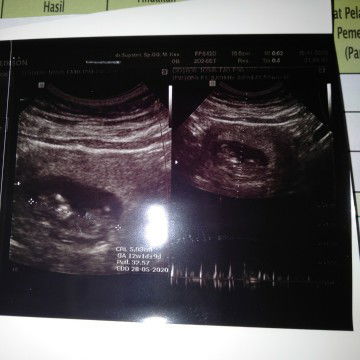 ini hasil USG saya 13minggu sekarang udah 4bulan