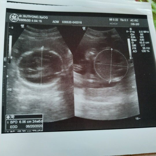 ketuban keruh atau tidak