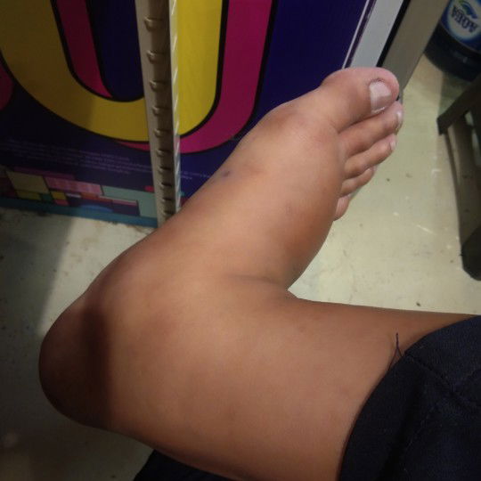kaki bengkak