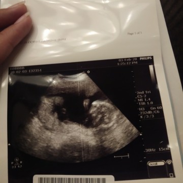 อัลตร้าซาวด์