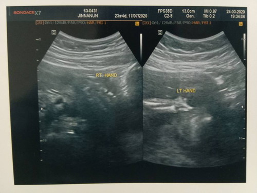 อัตตราซาวด์แล้วพบความผิดปกติมือซ้ายของลูกไม่ครบ