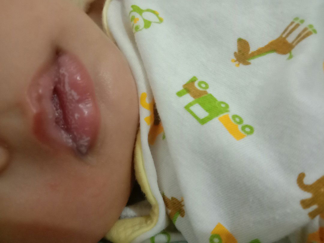 putih di bibir bayi