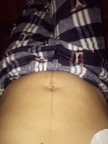 POSTPARTUM BELLY