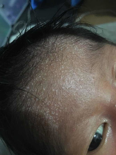 Cradle cap