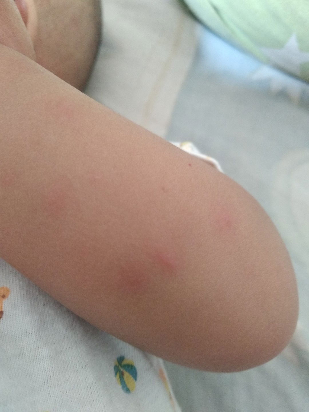 bentol atau jerawat bayi