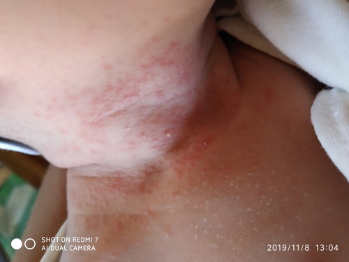 baby neck rashes