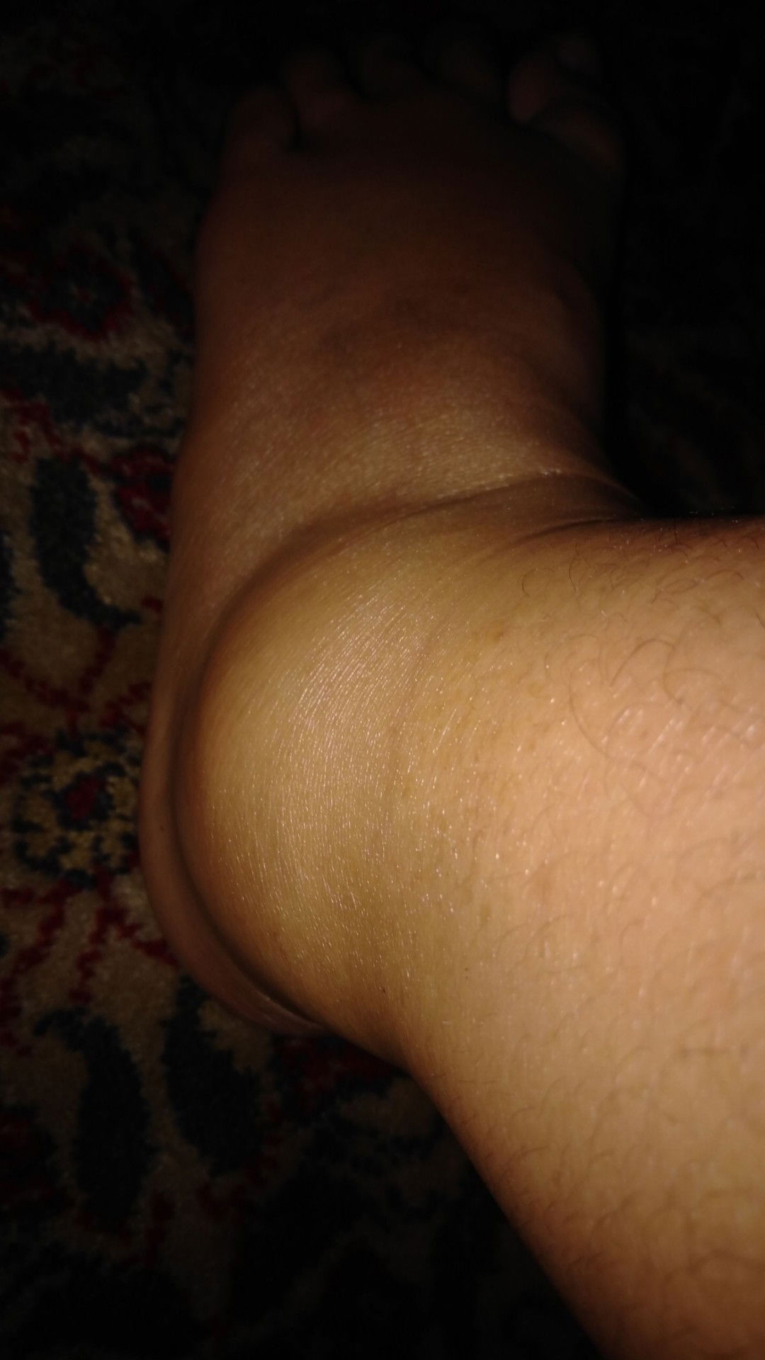 Kaki bengkak akibat keseleo