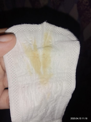 is it normal? discharge