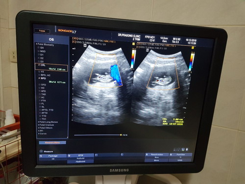 10w1d ภาพอัลตร้าซาวแม่ๆเป็นแบบไหนคะ
