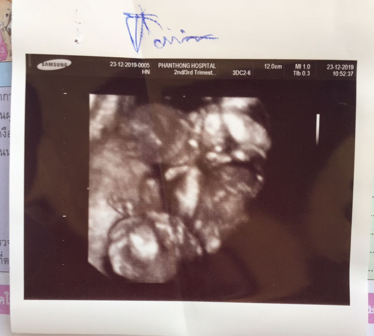 มีแม่คนไหนตั้งครรภ์แฝดบ้างค่ะ?‍?‍?