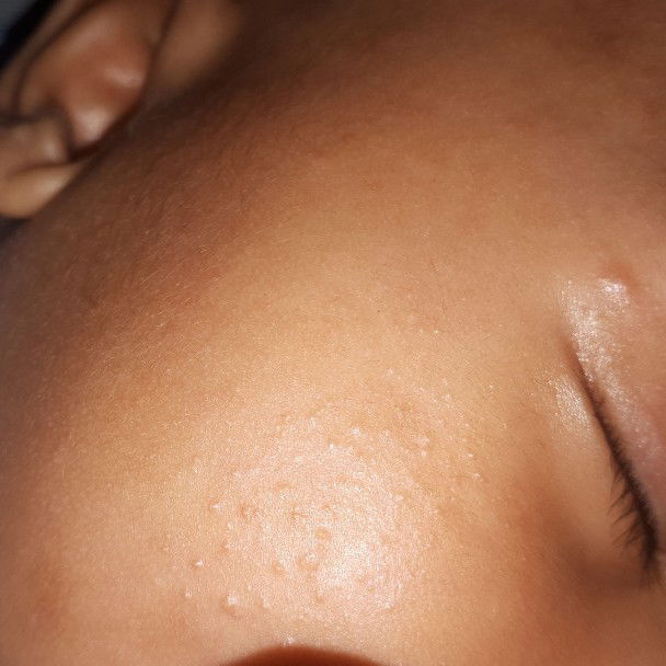 bintik di wajah bayi