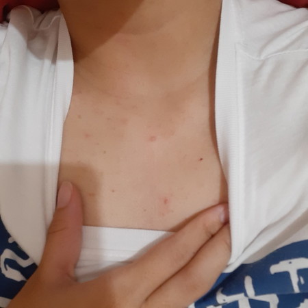 bacne and chest acne